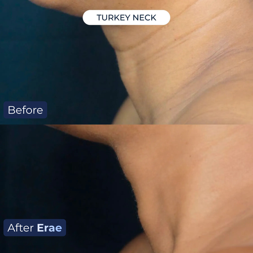 Erae™ Bio-Infusion